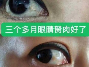 胬肉治疗免费观看(胬肉治疗免费观看：揭秘失传已久的民间特效秘方)