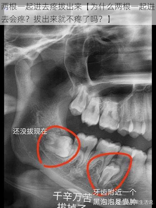 两根一起进去疼拔出来【为什么两根一起进去会疼？拔出来就不疼了吗？】